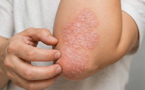 Psoriasis Treatment Homeopathy